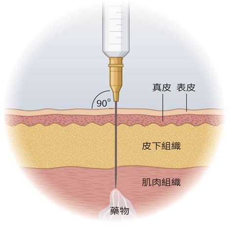 imi 位置|肌肉注射